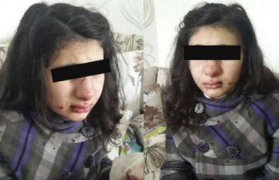 Məktəbli qıza hücum edilib - FOTO Məktəbli qıza hücum edilib - FOTO