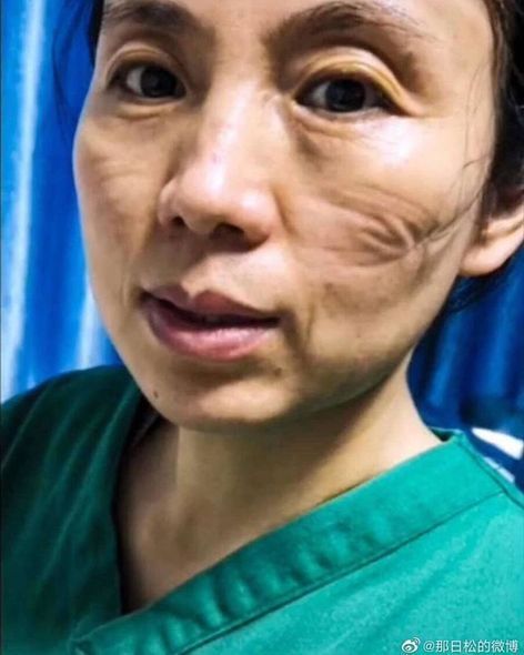 Çində koronavirus həkimləri bu vəziyyətə saldı – FOTO